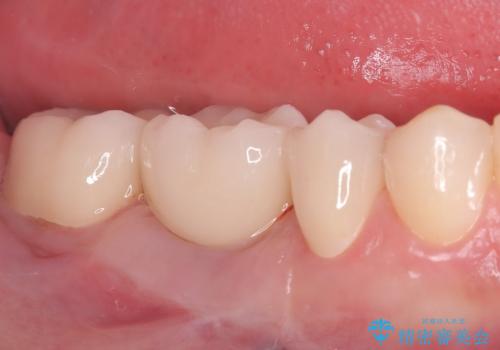 ブリッジからインプラントへの移行と歯周形成外科の症例 治療後
