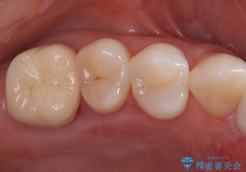 詰め物が外れた奥歯。MB2の発見の治療後