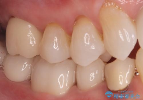 詰め物が外れた奥歯。MB2の発見の治療後