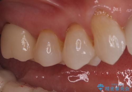 詰め物が外れた奥歯。MB2の発見の治療後