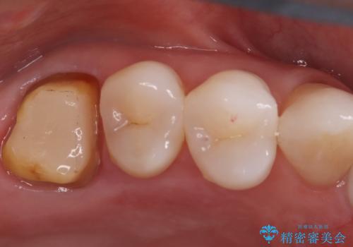 詰め物が外れた奥歯。MB2の発見の治療中