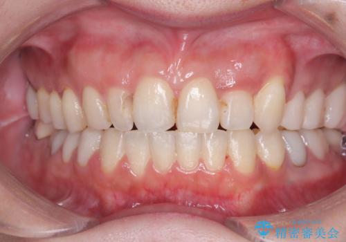 40代から始める歯並び改善。左上の八重歯を抜歯矯正ですっきりとの症例 治療後