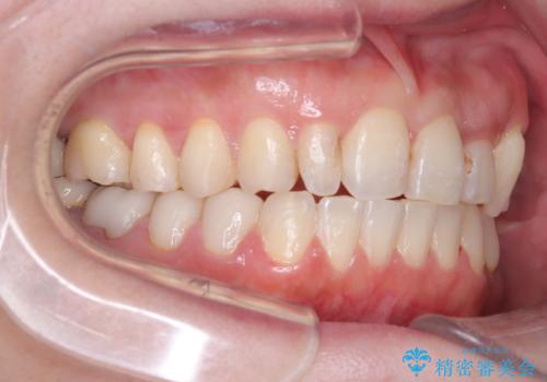 40代から始める歯並び改善。左上の八重歯を抜歯矯正ですっきりとの治療後