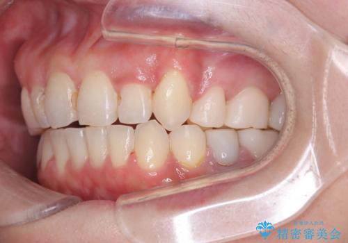 40代から始める歯並び改善。左上の八重歯を抜歯矯正ですっきりとの治療後