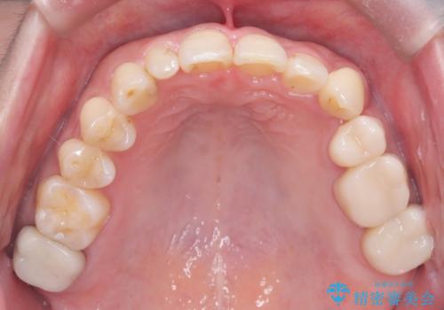 40代から始める歯並び改善。左上の八重歯を抜歯矯正ですっきりとの治療後