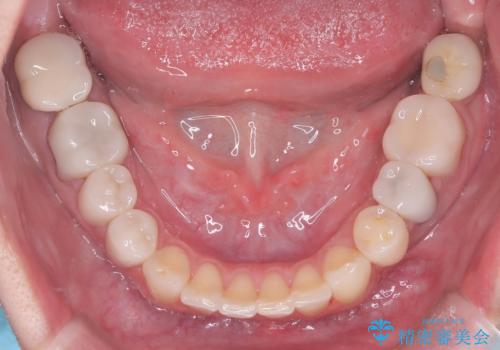 40代から始める歯並び改善。左上の八重歯を抜歯矯正ですっきりとの治療後