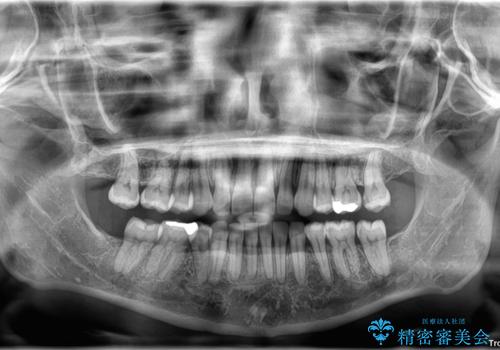 抜歯矯正で口が閉じやすく|ディープバイトと叢生を改善した症例の治療後