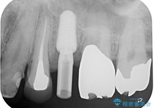 外科処置は1回のみ|抜歯即時インプラントで小臼歯を短期間で機能・審美回復した症例の治療中