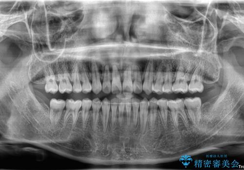 すきっ歯は放置NG?インビザラインで目立たず改善の治療後