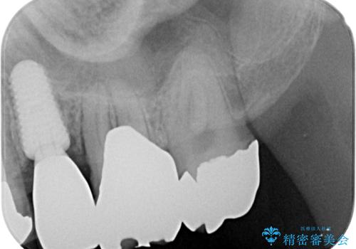 外科処置は1回のみ|抜歯即時インプラントで小臼歯を短期間で機能・審美回復した症例の治療後