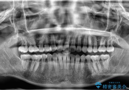 デコボコと正中のずれを改善した矯正治療の治療後