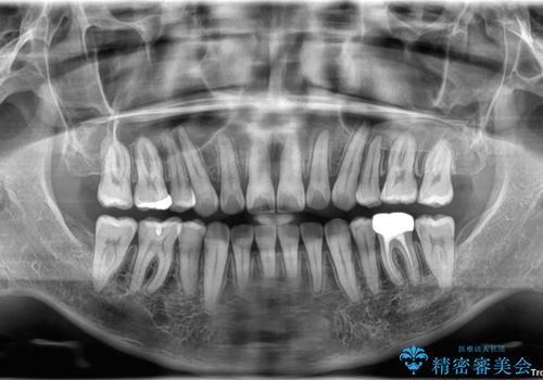 口が閉じにくい原因を根本から改善|上下顎4本抜歯による矯正治療症例の治療後