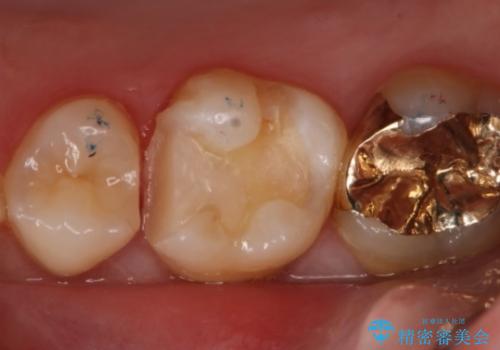 銀歯を金歯にしたい　ゴールドインレーの治療中