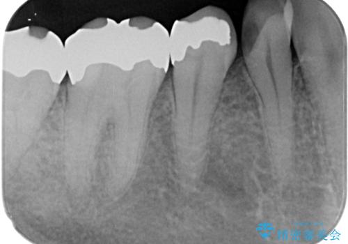 金属の詰め物が取れた オールセラミッククラウンの治療前