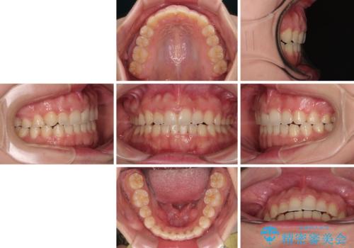 捻れて前に出ている前歯 ワイヤー装置での非抜歯矯正の治療後