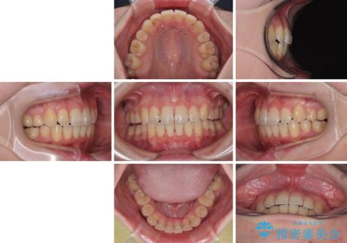 デコボコだらけの歯列をきれいに ワイヤー装置での抜歯矯正治療の治療後