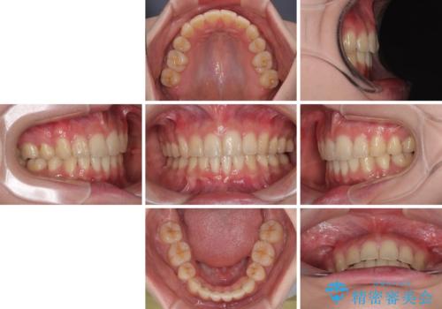 深い咬み合わせと飛び出した前歯 ワイヤー装置での抜歯矯正治療の治療後