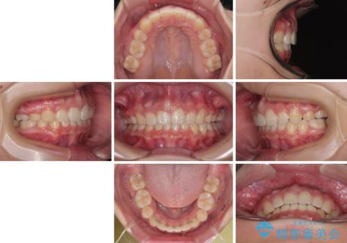 唇が閉じられない　ワイヤー装置による抜歯矯正治療の治療後