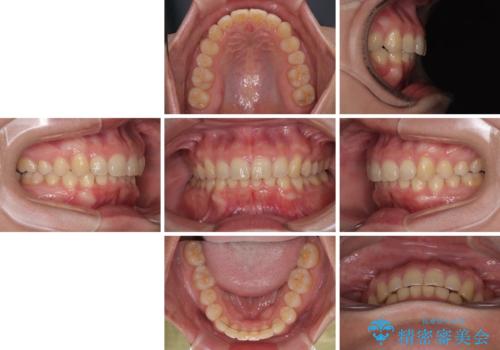隠れた前歯が気になる ディープバイトのワイヤー矯正治療の治療後