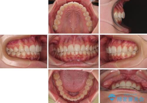 デコボコと咬み合わせを改善　インビザライン矯正治療の治療後