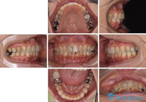 むし歯治療とインビザライン矯正治療 総合歯科治療で整った口腔内にの治療後