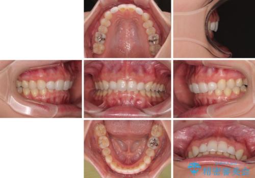 前歯のデコボコと小さい歯を改善 インビザラインとオールセラミッククラウンの治療後