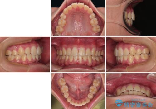 全体的なデコボコをスッキリと　ワイヤー装置での抜歯矯正の治療後