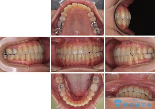 受け口と八重歯を改善　インビザライン矯正治療の治療後