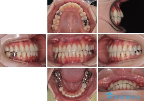 【モニター】前歯のデコボコをインビザラインで綺麗にの治療後