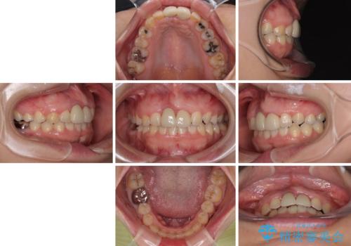 前歯のデコボコをワイヤー矯正で綺麗に　保険診療の前歯クラウンもセラミッククラウンで自然にの治療後