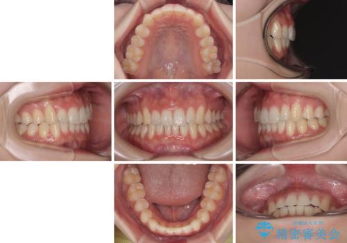前歯が隠れるほどのデコボコをインビザライン矯正できれいに整えるの治療後