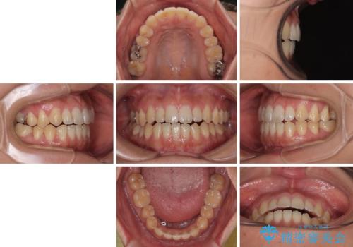 【モニター】食事が取りづらい 極端な開咬をインビザラインで解決の治療後