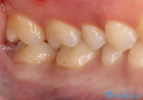 奥歯を良いもので治したい　セラミックインレーの治療中