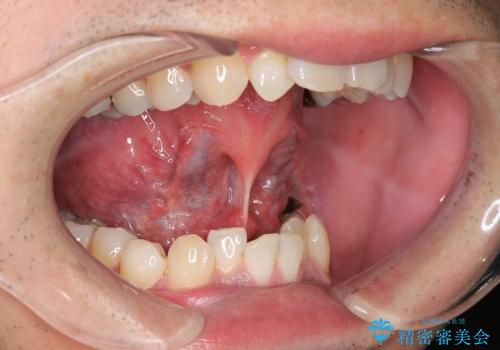 【舌小帯切除】ら行が言いづらいの治療前