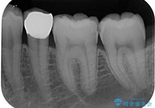 左下にフロスを通すと引っかかる　オールセラミッククラウンの治療後