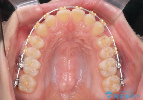 深い噛み合わせ、すきっ歯の改善 ワイヤーを用いたマルチブラケット矯正の治療中