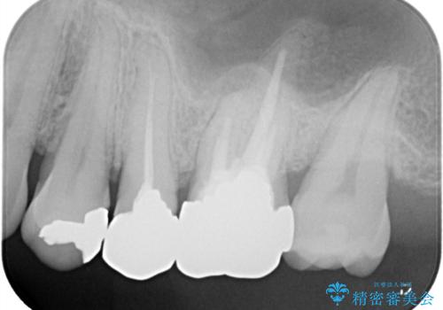 全ての銀歯をセラミックへ。お口全体をメタルフリーにして笑顔まで明るくの治療前