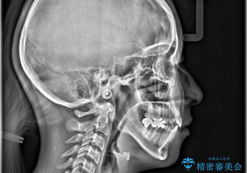 開咬・叢生(八重歯)を抜歯矯正で改善|ワイヤー矯正(クリア装置)症例の治療後