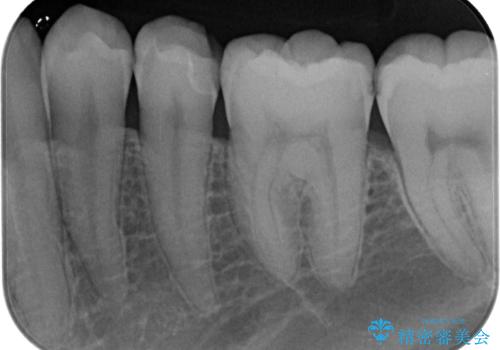 左下にフロスを通すと引っかかる オールセラミッククラウンの治療前