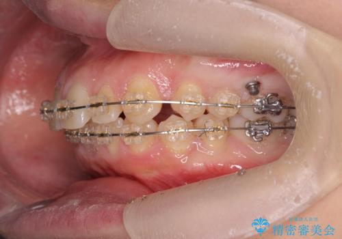 深い噛み合わせ、すきっ歯の改善　ワイヤーを用いたマルチブラケット矯正の治療中