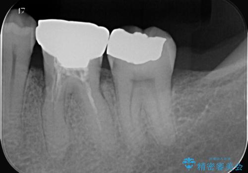 全ての銀歯をセラミックへ。お口全体をメタルフリーにして笑顔まで明るくの治療前