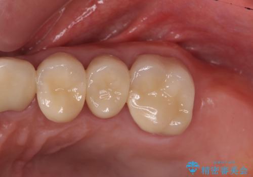 歯ブラシのしやすいクラウンへのやりかえの治療後