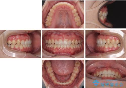 すきっ歯は放置NG?インビザラインで目立たず改善の治療中
