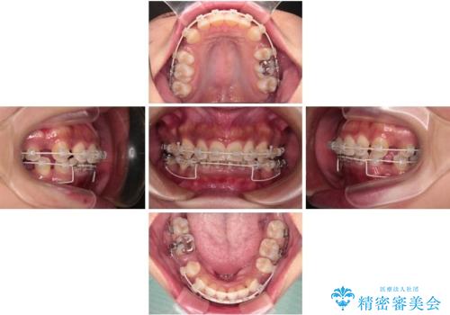 抜歯矯正で口が閉じやすく|ディープバイトと叢生を改善した症例の治療中