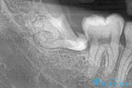 親知らず抜歯後、虫歯治療の治療前