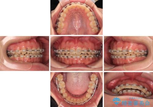 捻れて前に出ている前歯 ワイヤー装置での非抜歯矯正の治療中