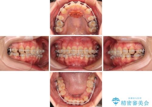 デコボコだらけの歯列をきれいに　ワイヤー装置での抜歯矯正治療の治療中