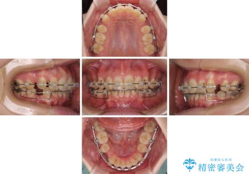 深い咬み合わせと飛び出した前歯　ワイヤー装置での抜歯矯正治療の治療中