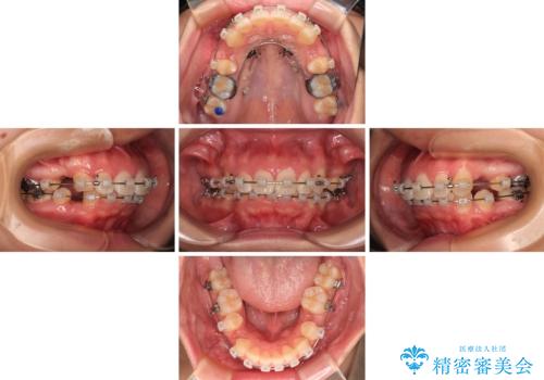 唇が閉じられない　ワイヤー装置による抜歯矯正治療の治療中