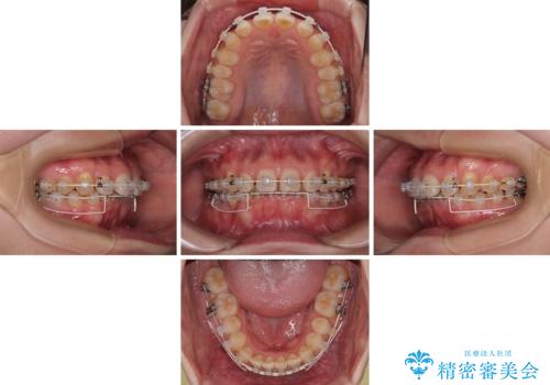 隠れた前歯が気になる ディープバイトのワイヤー矯正治療の治療中
